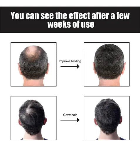 SelenoraBeauty™ East Moon Men’s Dense Hair Serum – Vitamin E Hair Growth Oil | Strengthening, Anti-Hair Loss, Scalp Repair & Moisturizing Treatment (30ml)