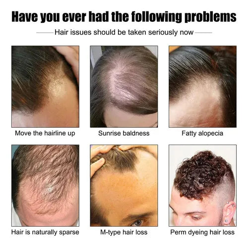 SelenoraBeauty™ East Moon Men’s Dense Hair Serum – Vitamin E Hair Growth Oil | Strengthening, Anti-Hair Loss, Scalp Repair & Moisturizing Treatment (30ml)